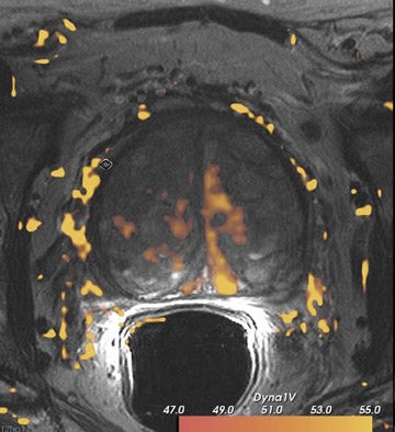 SIR 2026 | Study Finds Minimally Invasive Prostate Cancer Therapy Linked to Faster Recovery