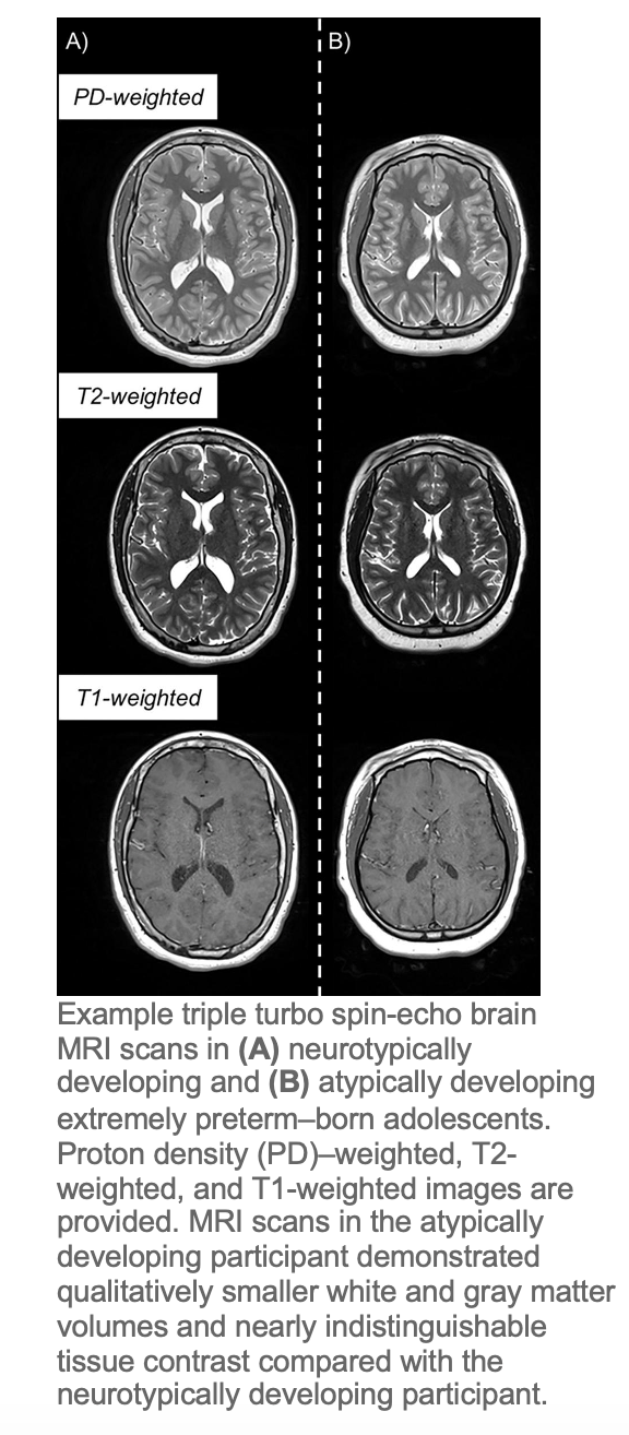MRI Detects Atypical Brain Development in Premature Babies