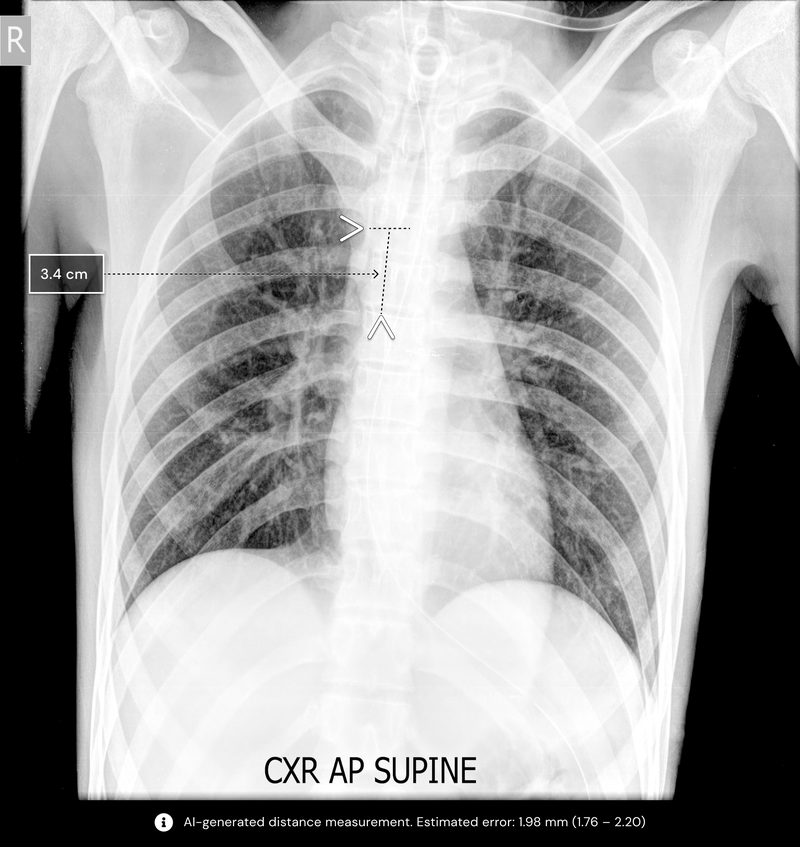AI Improves Critical Care Management for Improper Tube Placements