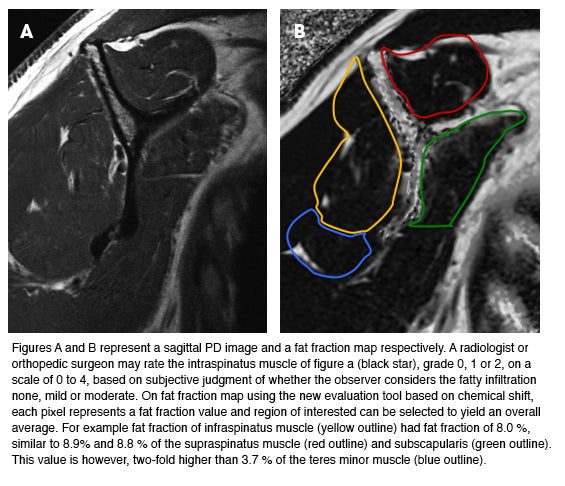 New technique improves rotator cuff tear assessment