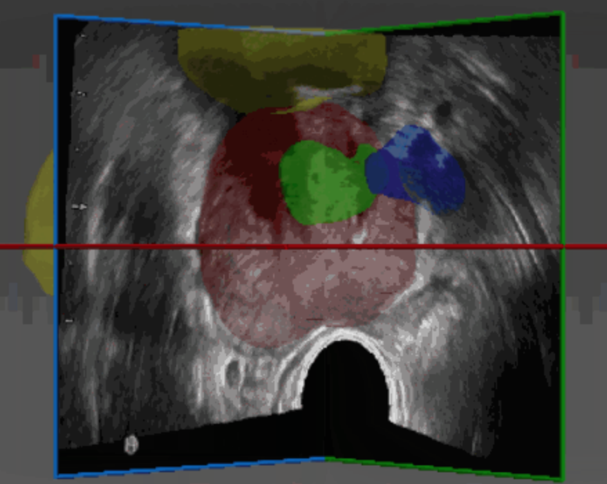 AI-Based Tool for Prostate MRI and Ultrasound Registration Enables Precise Navigation