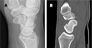 Single-shot CT recommended for wrist trauma