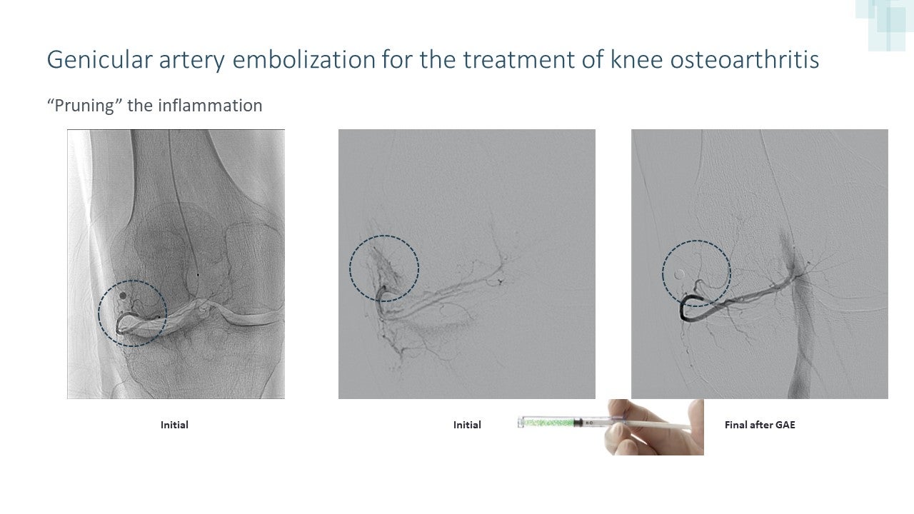 Non-surgical Treatment for Arthritis of the Knee Provides Immediate and Long-term Relief