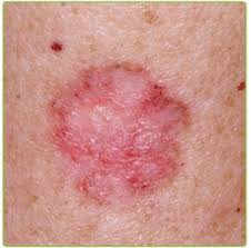 Kaiku Health, Novartis Expand Partnership in Melanoma Cancer Care