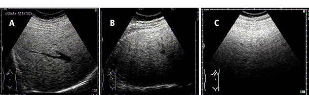 Ultrasound and transient elastography: Screening exams for type 2 diabetes mellitus patients
