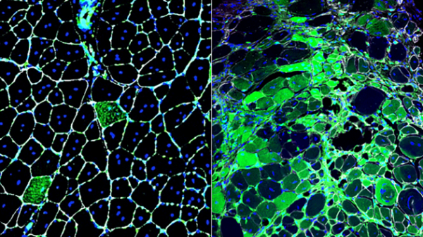 Columbia University to Collaborate with Actinium Pharmaceuticals on Leukemia Patient Study