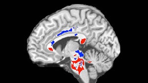Study Reveals Neighborhood Socioeconomic Status Influences Brain Health