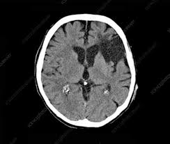 Women With Large Vessel Occlusion Less Likely Than Men to be Sent to Comprehensive Stroke Centers
