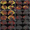 HT-ALZ Therapeutic Shows Potential to Reduce Amyloid β in Alzheimer's Disease