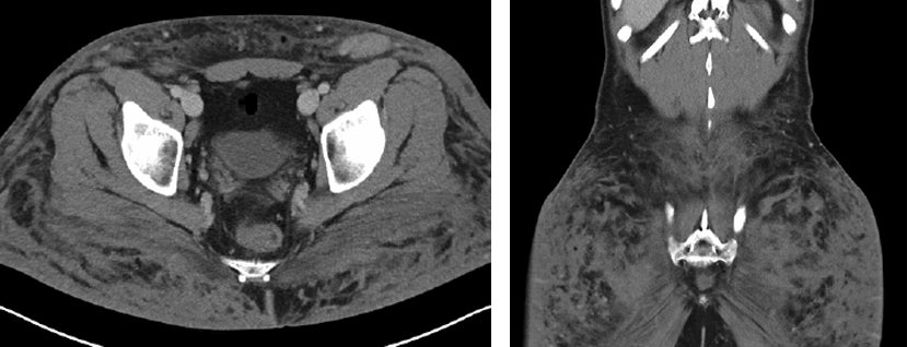Imaging transgender patients: Findings and complications