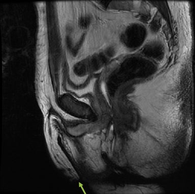 Imaging transgender patients: Findings and complications