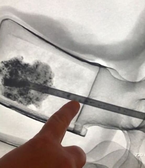 New Solution Offers Real-Time Flow Visualization During Cement Injection